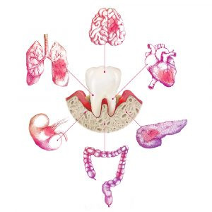 Periodontitis and systemic diseases, illustration