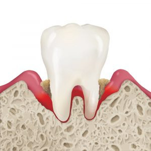 Periodontitis, illustration
